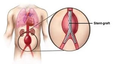 Aort Damarı Özellikleri ve Faydaları Nelerdir? Aort Damarı Özellikleri ve Faydaları Nelerdir?