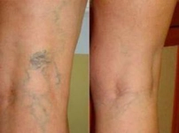 Damar Çekilmesi Belirtileri ve Tedavisi Damar Çekilmesi Belirtileri ve Tedavisi