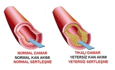 Damar Tıkanıklığı Belirtileri ve Tedavisi Damar Tıkanıklığı Belirtileri ve Tedavisi