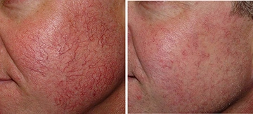 Kılcal Damar Özellikleri ve Faydaları Nelerdir? Kılcal Damar Özellikleri ve Faydaları Nelerdir?