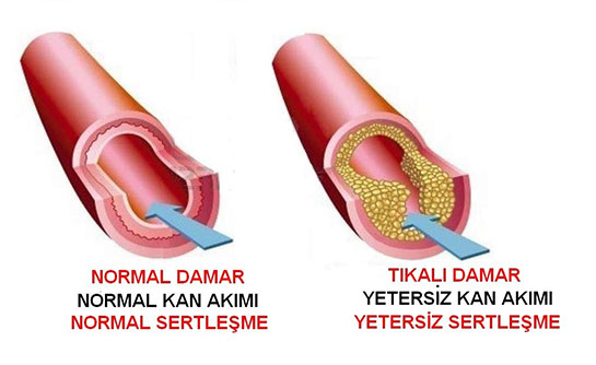 Damar Tıkanıklığı Belirtileri ve Tedavisi